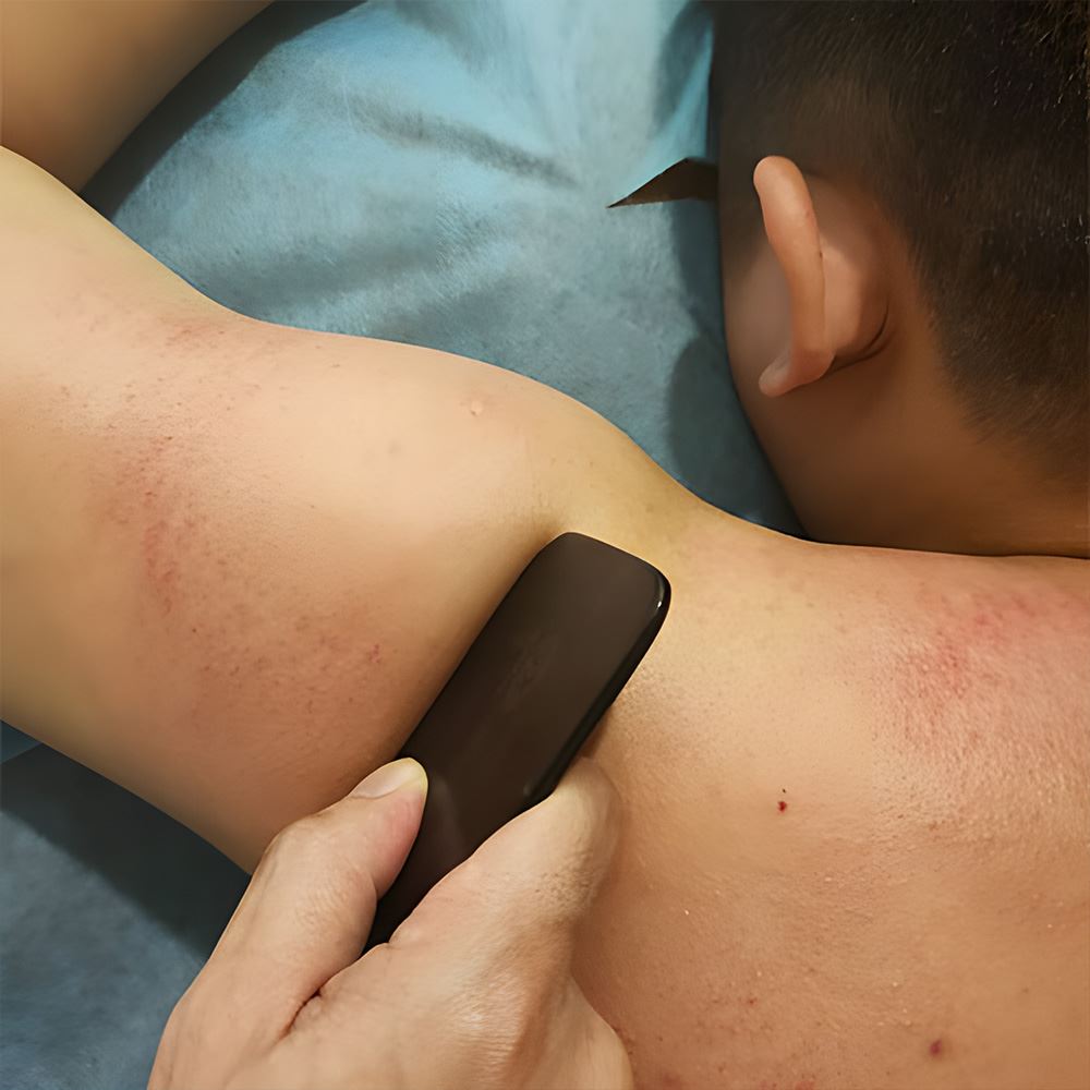 Scraping – Gua Sha